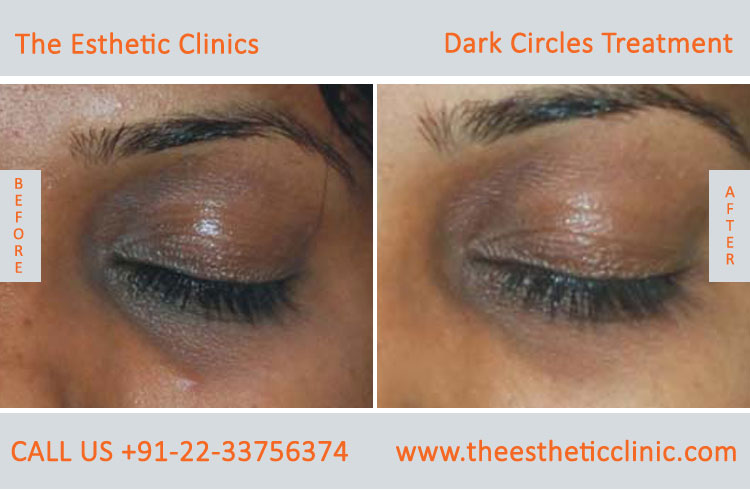 Under Eye Dark Circle Removal Laser Treatment before after photos in mumbai india (3)